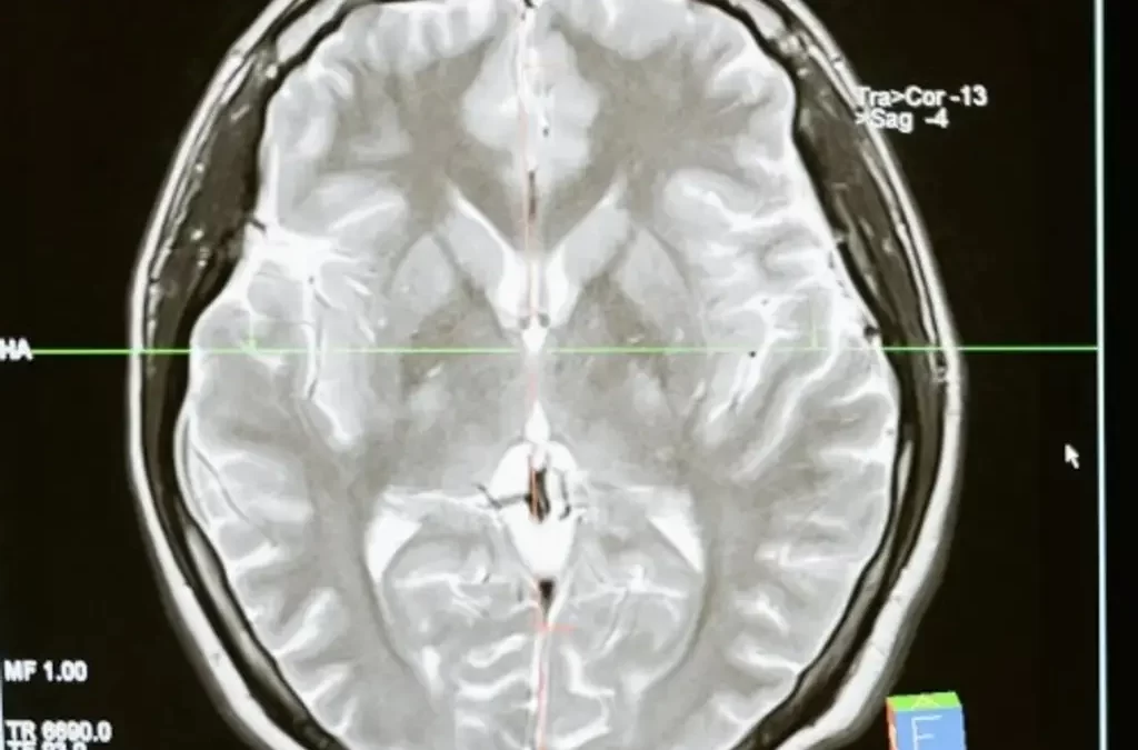 Crean células capaces de eliminar uno de los peores tumores cerebrales