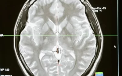 Crean células capaces de eliminar uno de los peores tumores cerebrales